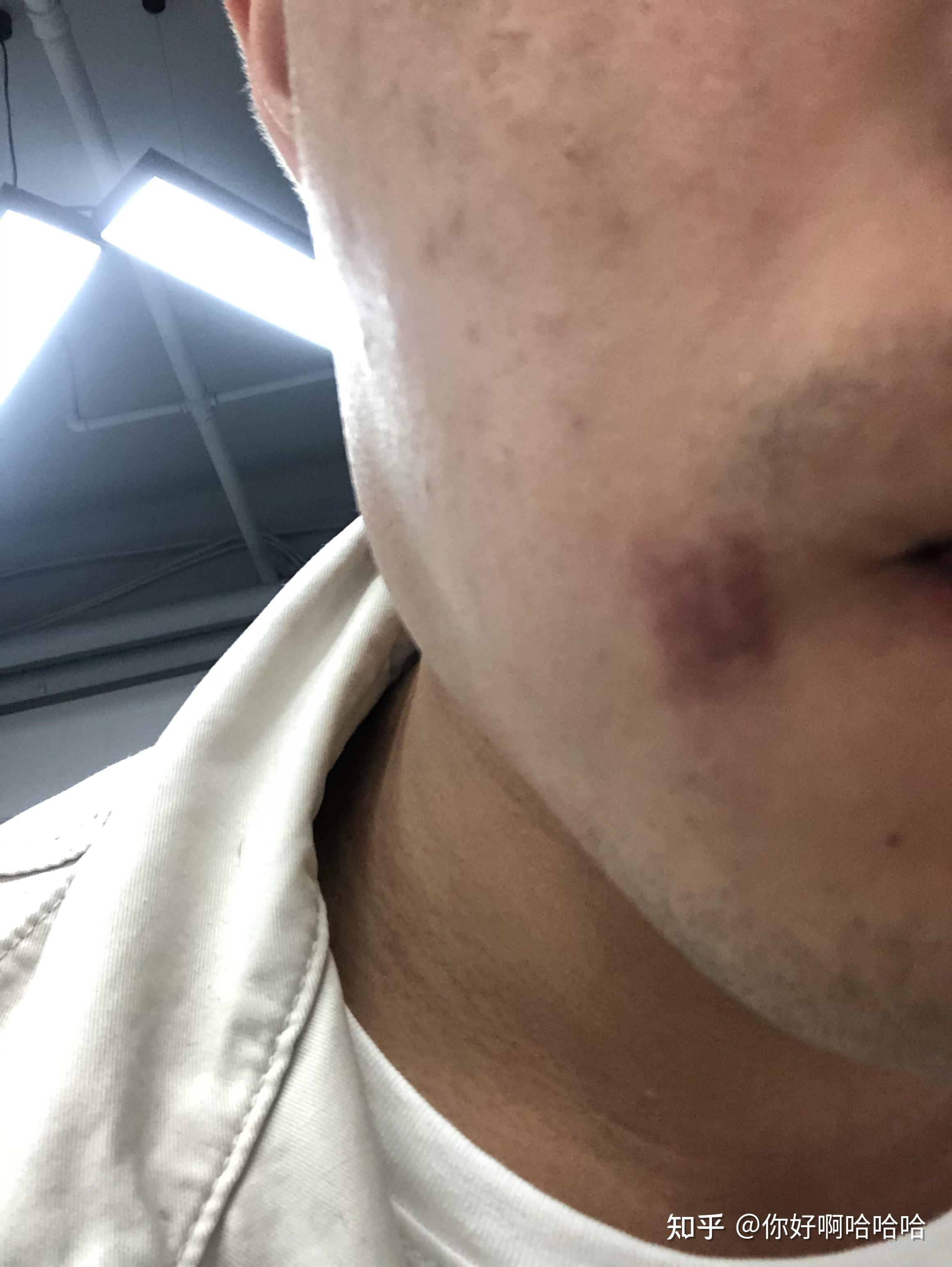 嘴角突然出现一块红斑怎么回事