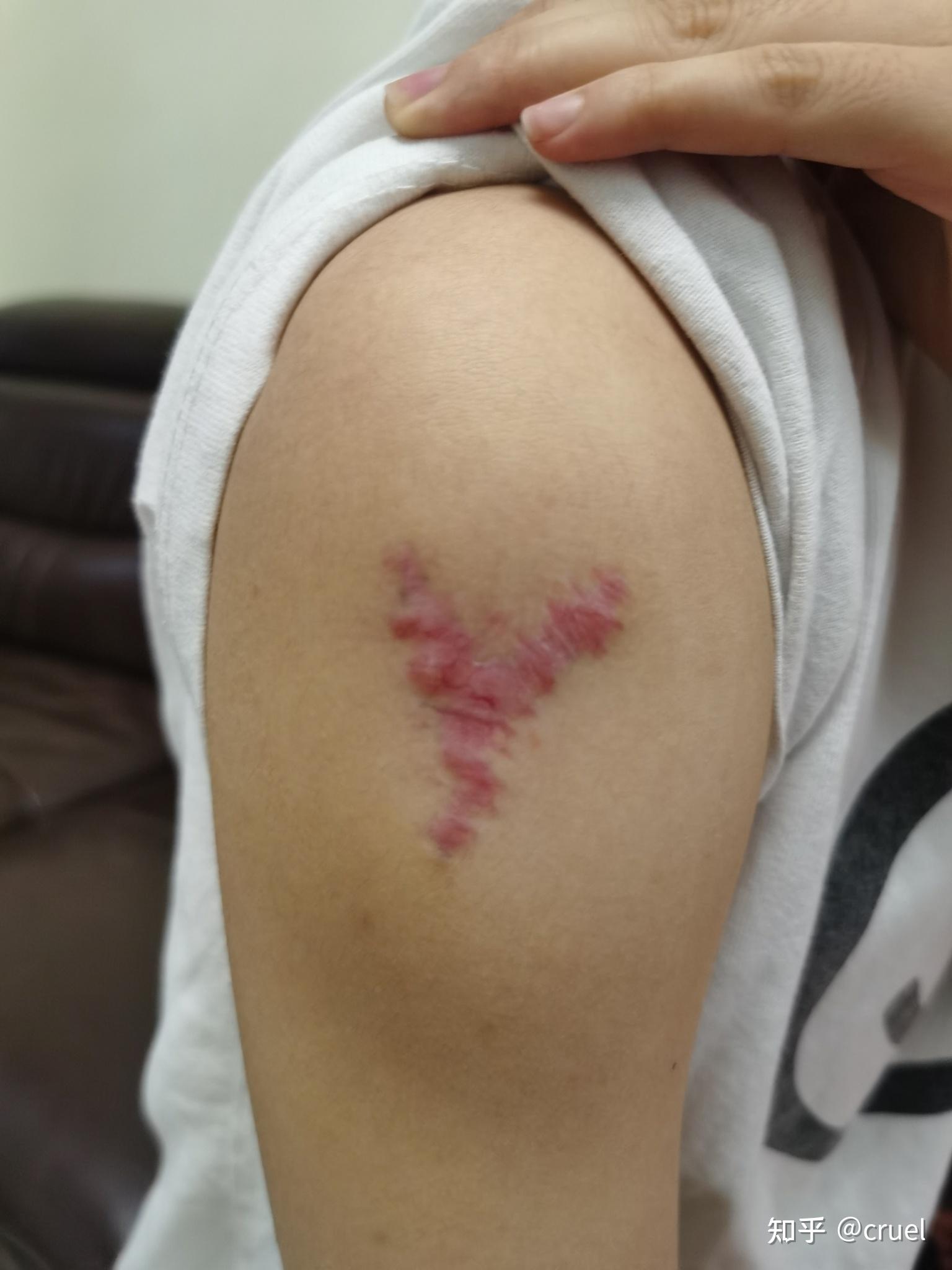 切除纹身应该去那个科 费用 有人知道嘛? - 知乎