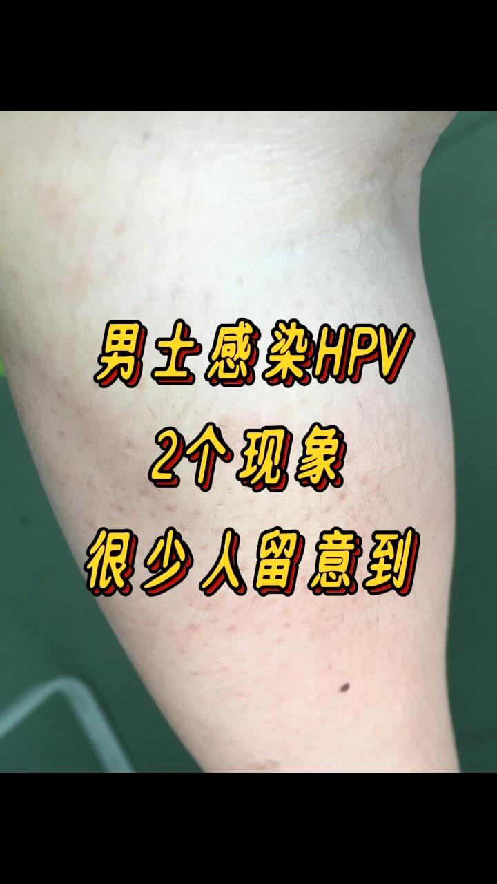 男性hpv真实图片 取样图片