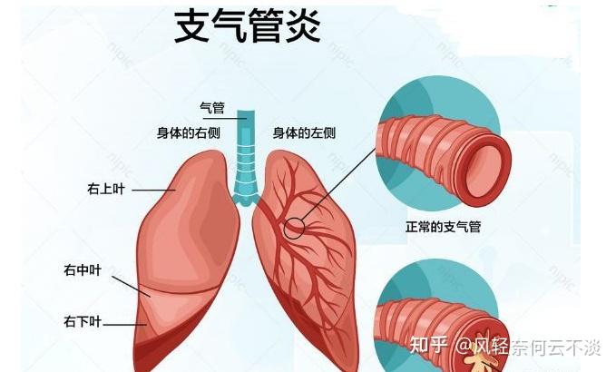 引起支气管炎的原因有哪些？ - 知乎