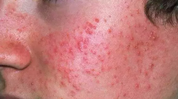 为什么从没用过激素药膏的我最终成了激素脸