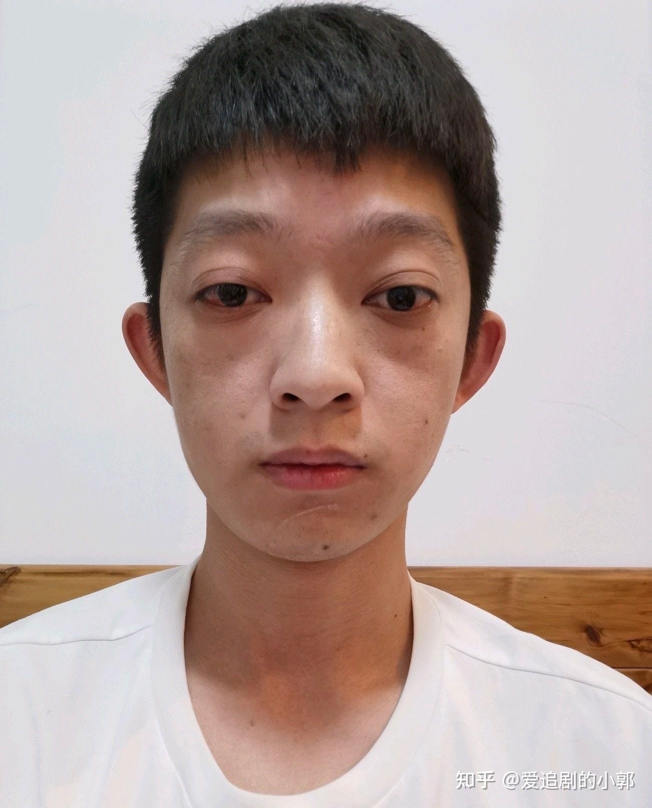 给甲亢凸眼的病友们提供一个我的案例参考