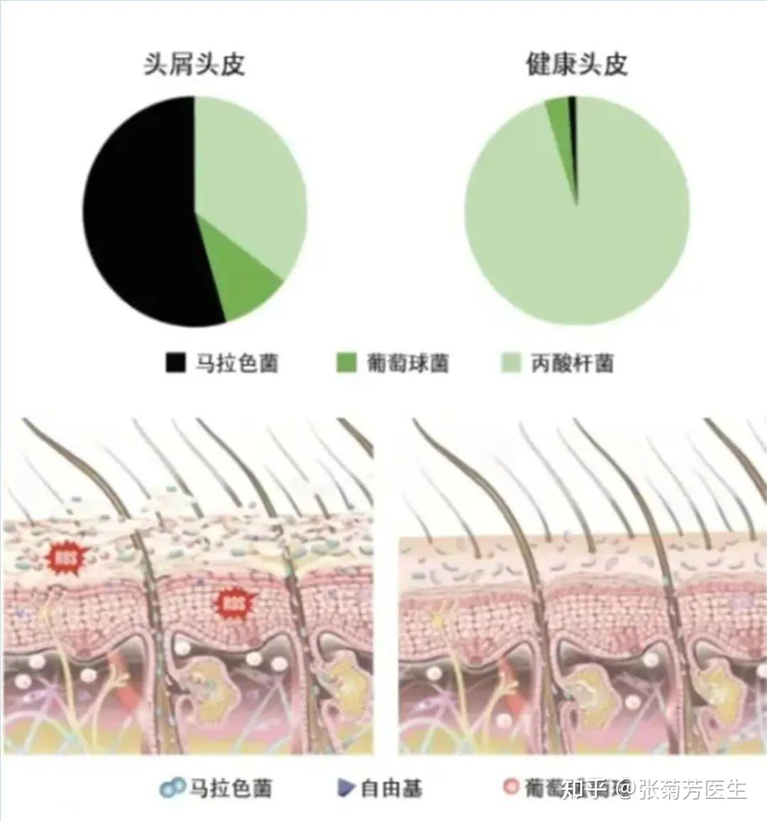 解决头皮问题的小妙招——头皮刷酸 - 知乎