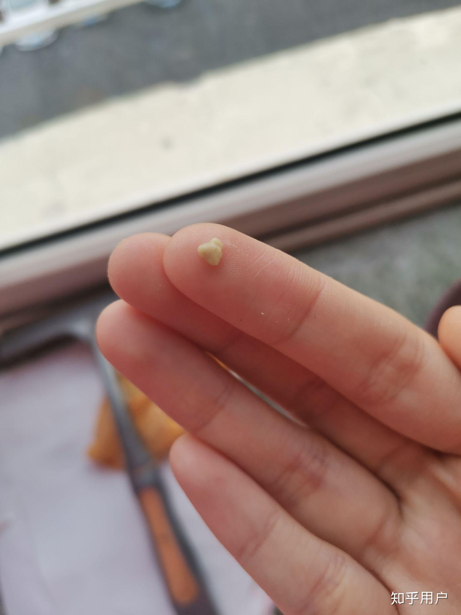 看知乎上那么多人都能自己清理扁桃体结石就我不能为什么