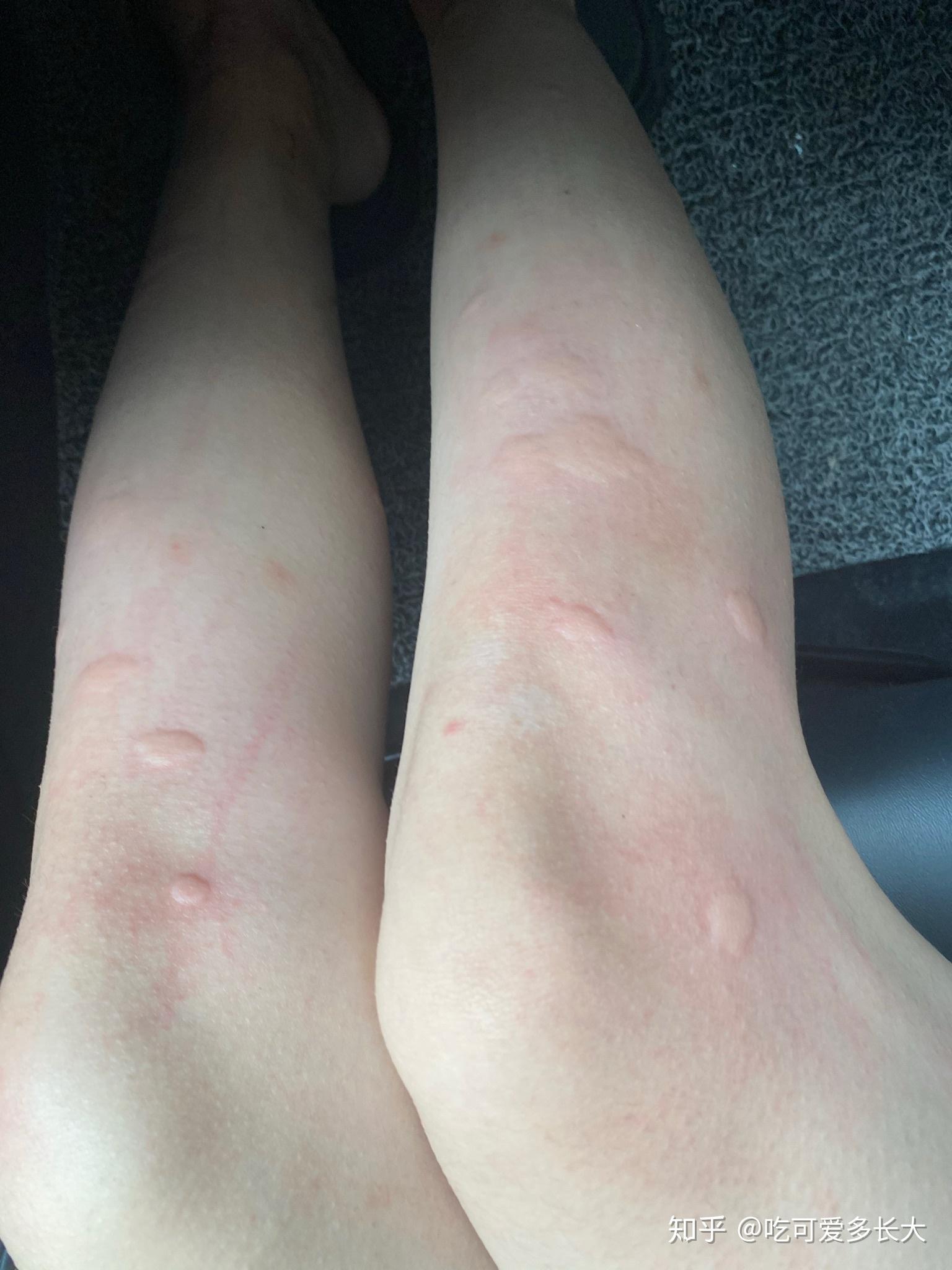 在南方被毒蚊子咬是一种怎样的体验