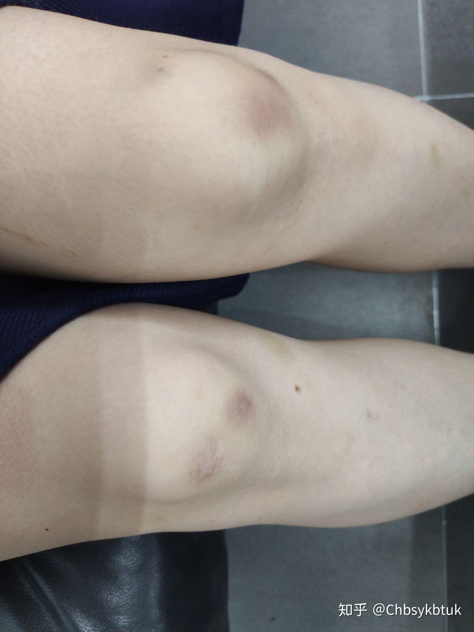 怎么向男朋友解释膝盖淤青,女孩子膝盖淤青是什么情况,真的是污吗?