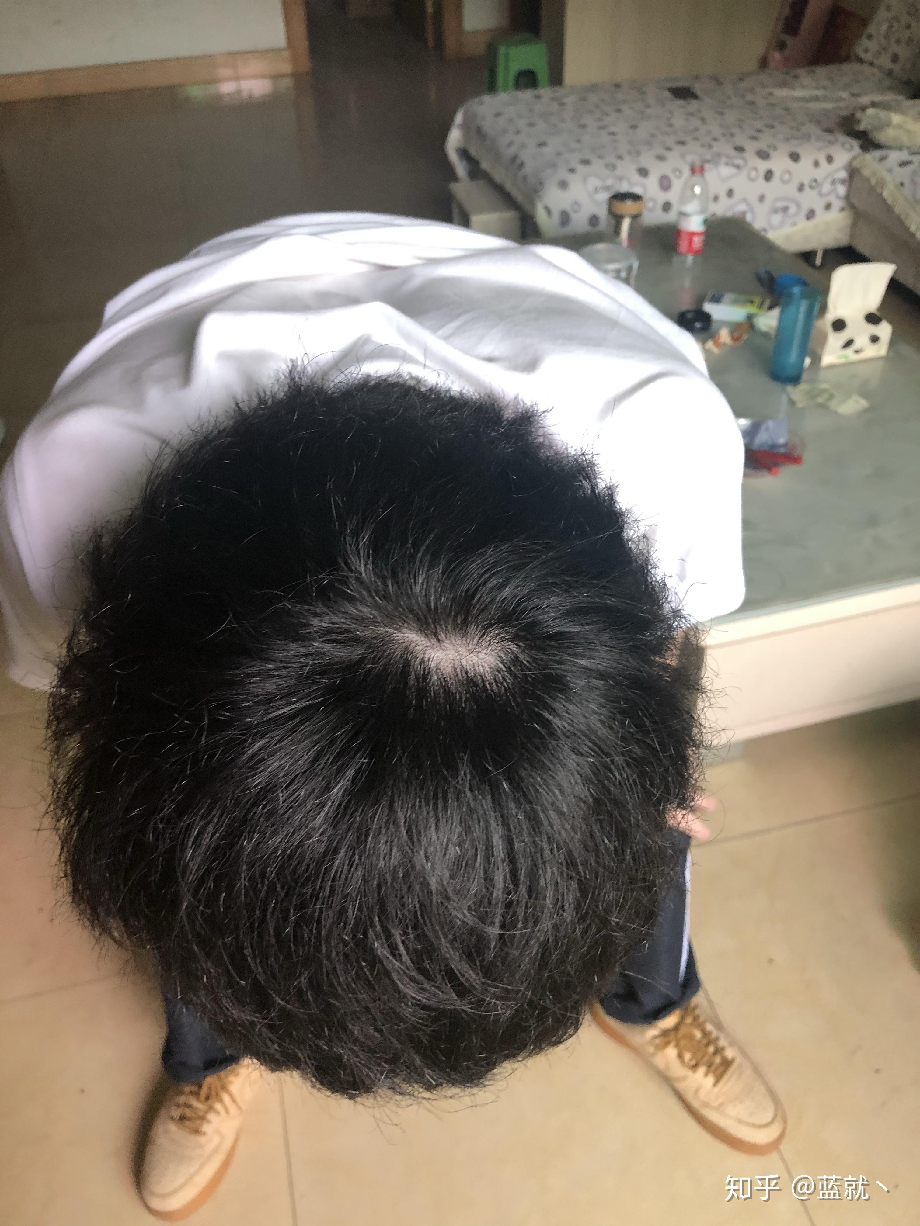 什么样子的发旋是正常的啊? - 知乎