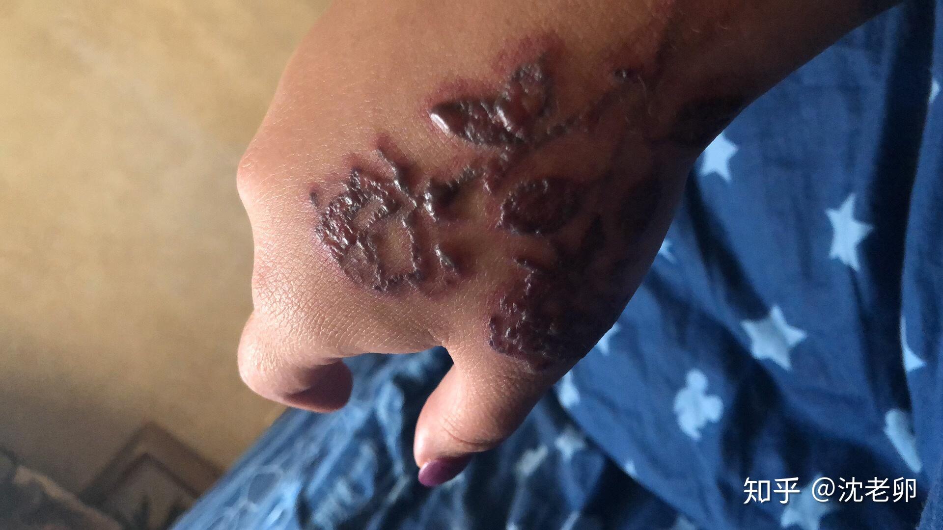 洗纹身起水泡了怎么办