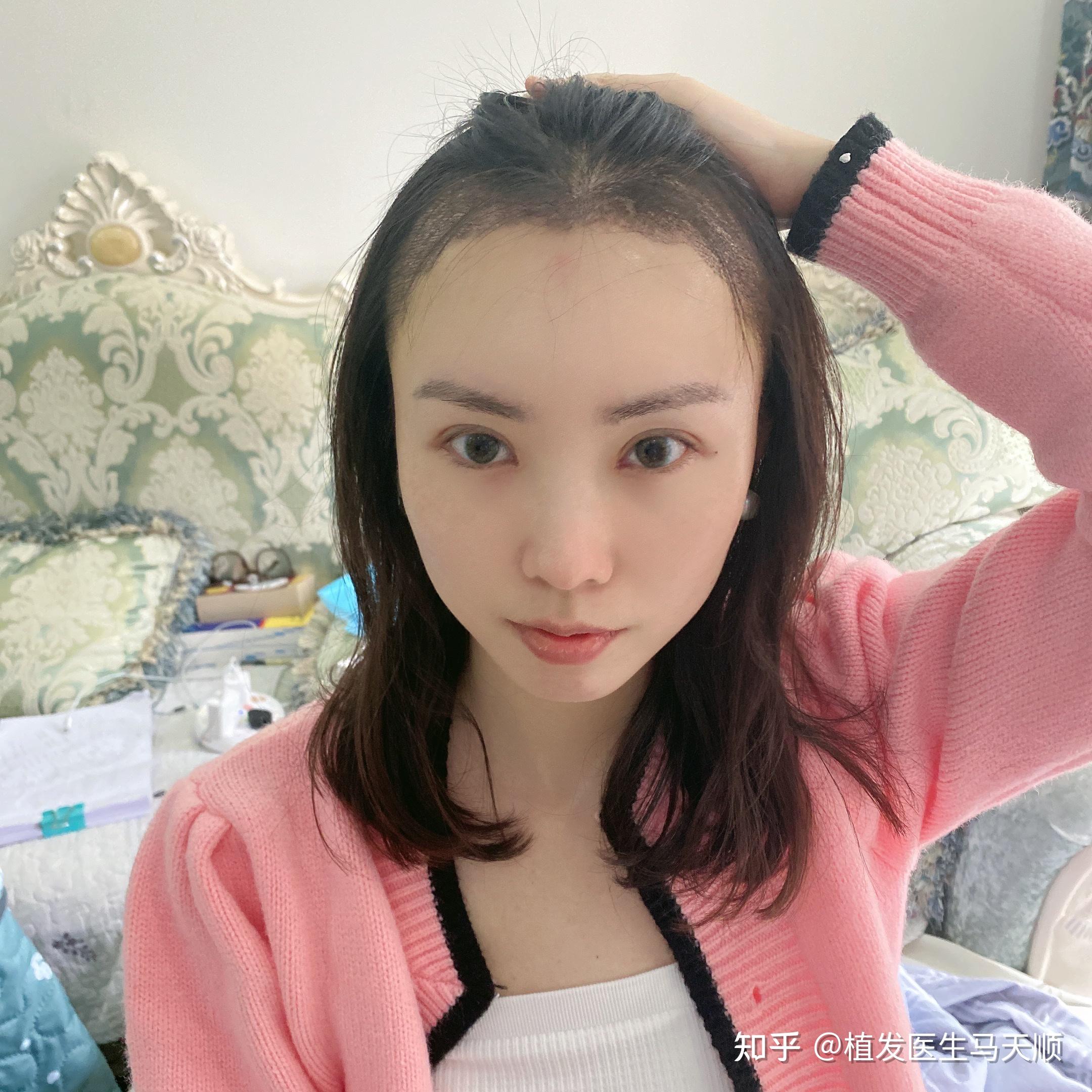 女性天生发际线比较高，脑门大，脑门凸出，可以选择植发吗？植发需要多少钱? - 知乎