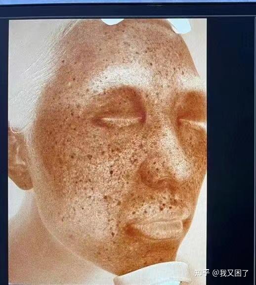 为什么有的痘印很难祛除? - 知乎