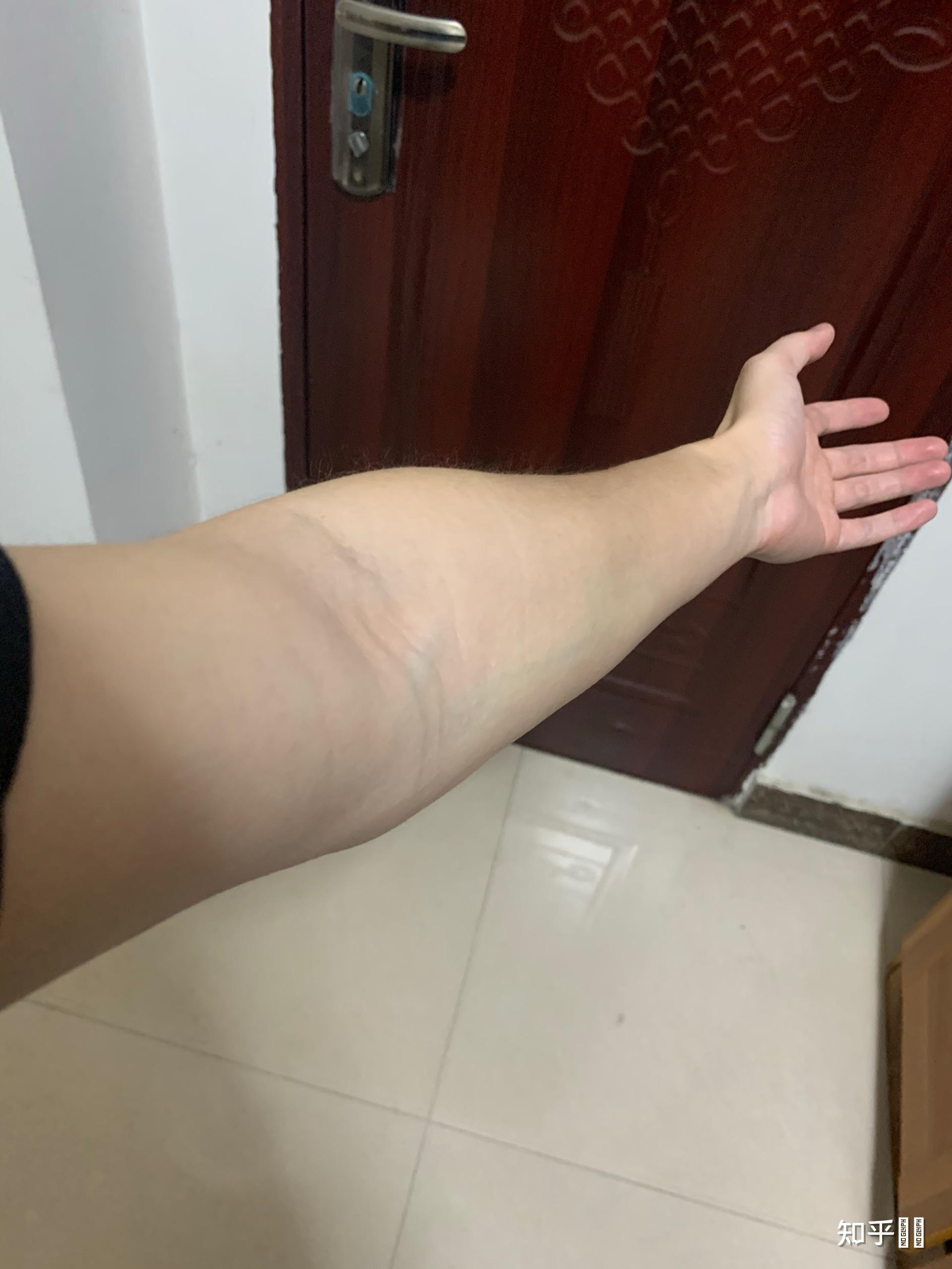 我出生时臂丛神经损伤现在20几岁了感觉肌肉明显萎缩该如何锻炼