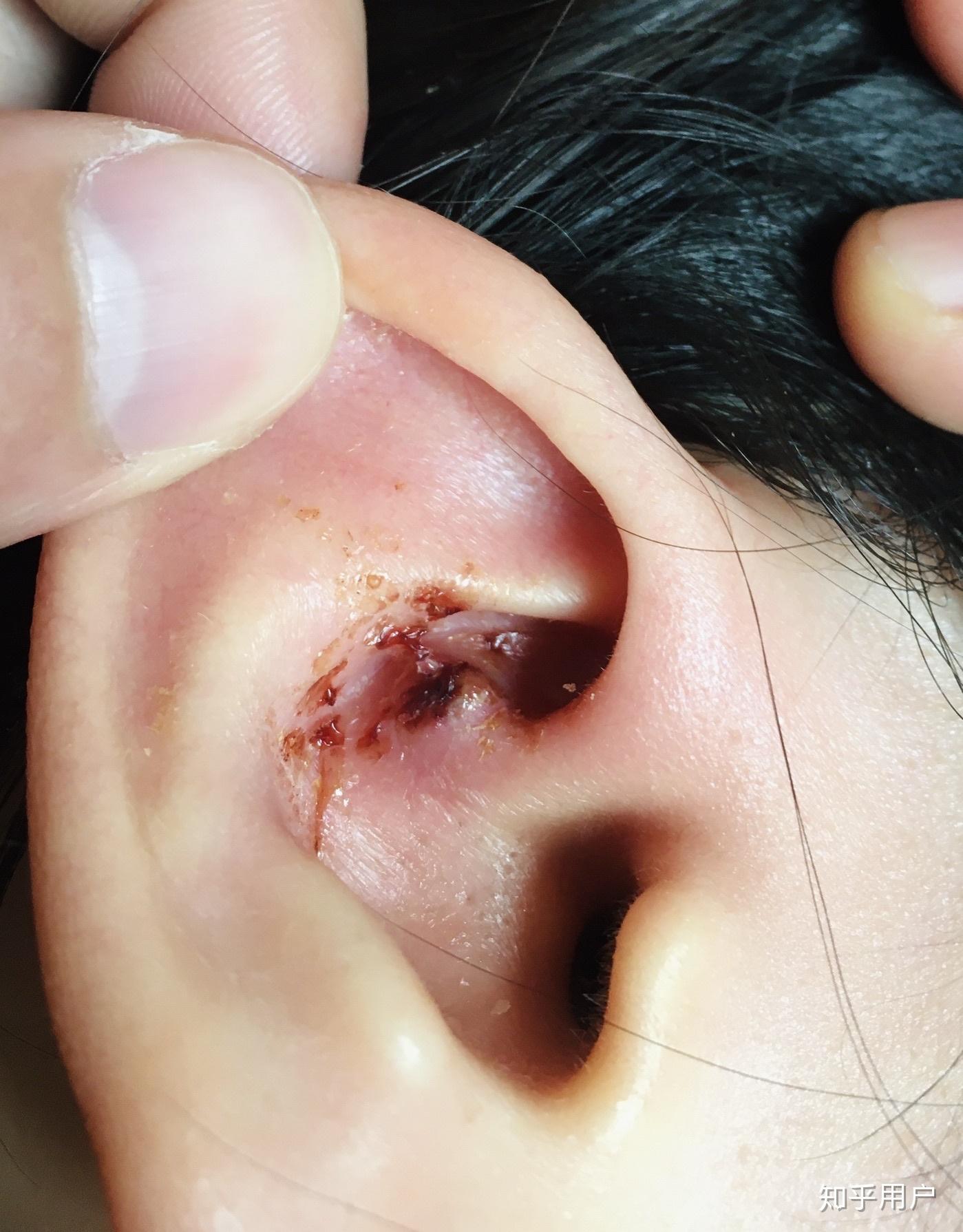 耳朵里长痘痘是一种什么体验