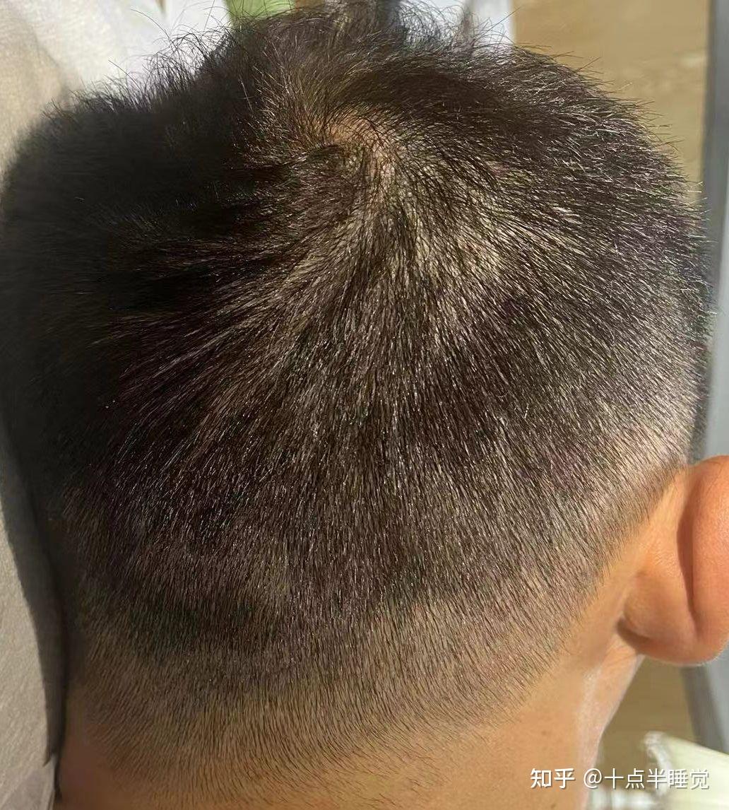 我的植发经历 - 知乎