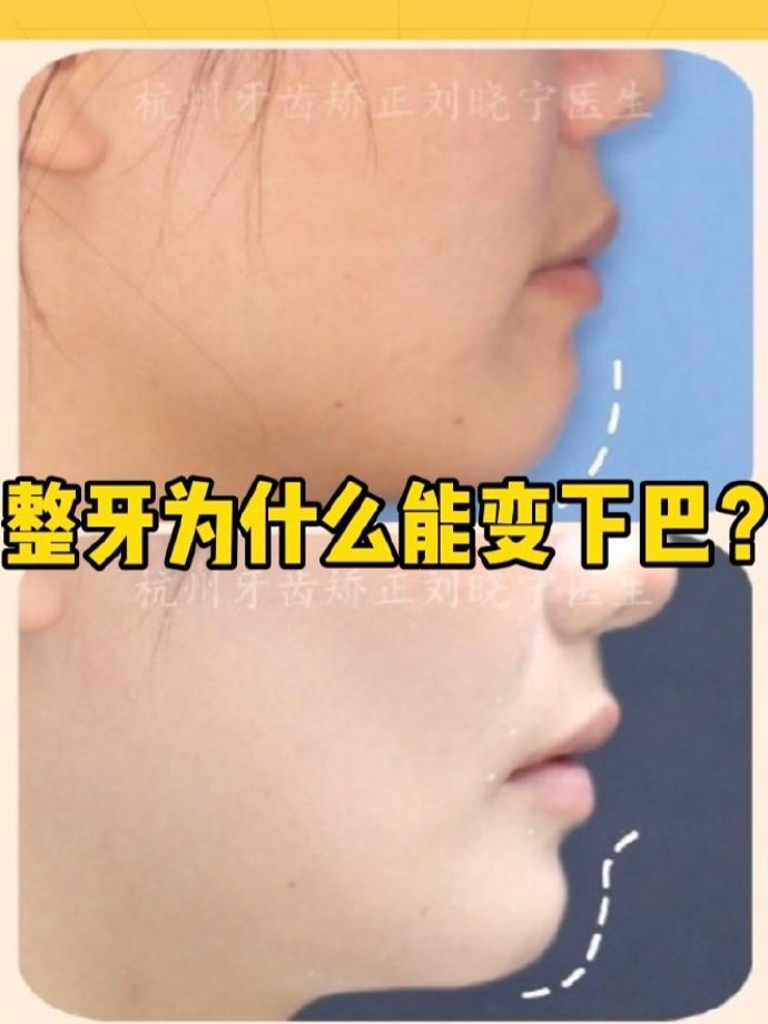 杭州牙齿矫正丨整牙为什么可以让下巴看起来更翘了?