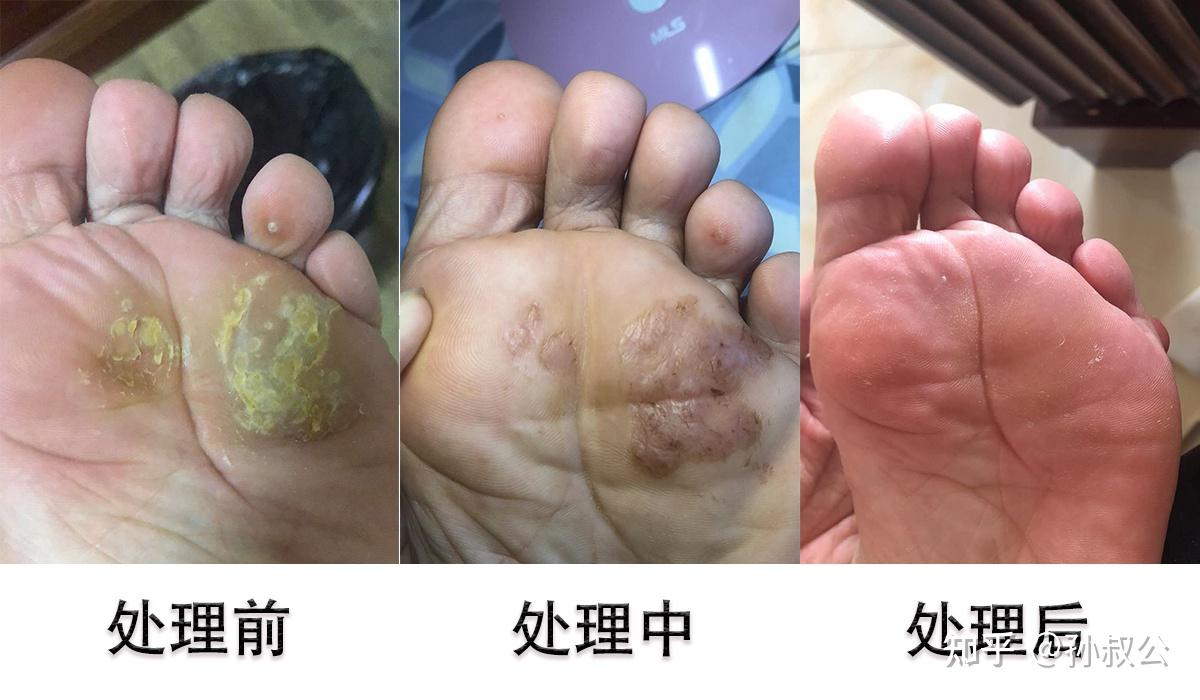 手摸了跖疣周围皮肤会传染到其他地方吗救命