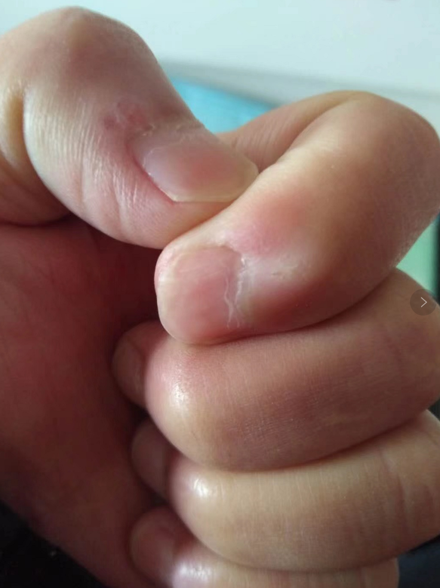 手上的病毒疣长了3年,冷冻两次无效,接着做了一次激光还是无效,而且