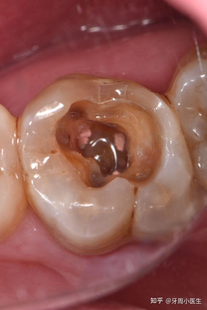 根管补过的牙会很容易破吗