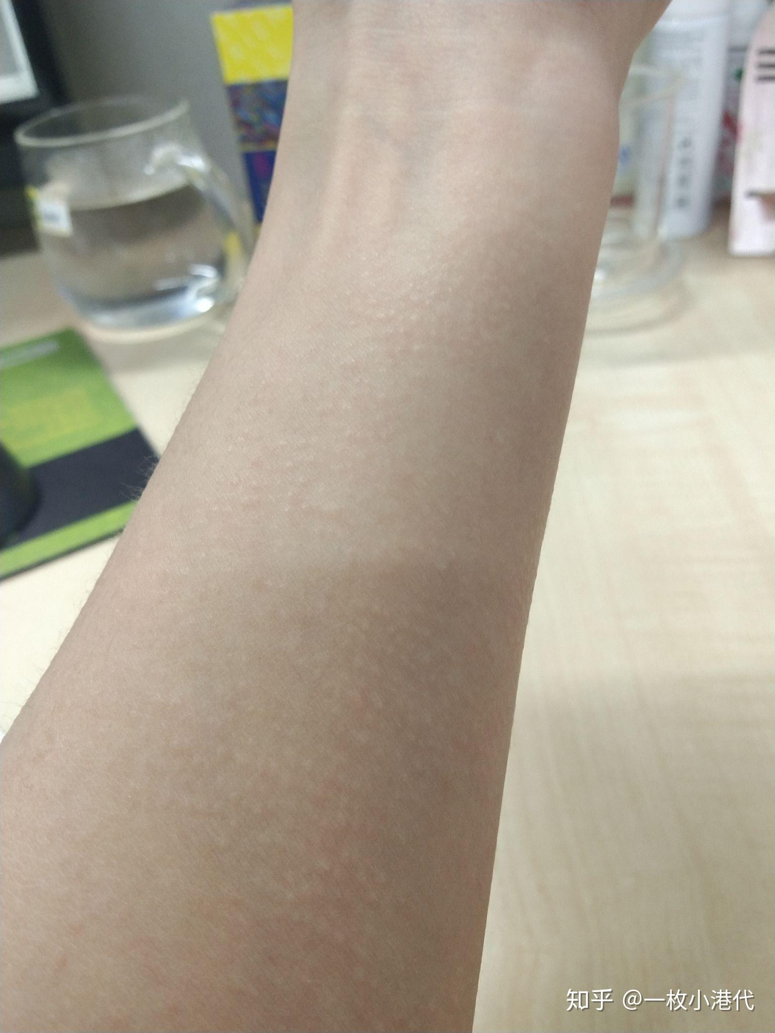 手臂,脖子,还有肚子的皮肤都有好多这样的像鸡皮疙瘩的白点,不痛不痒