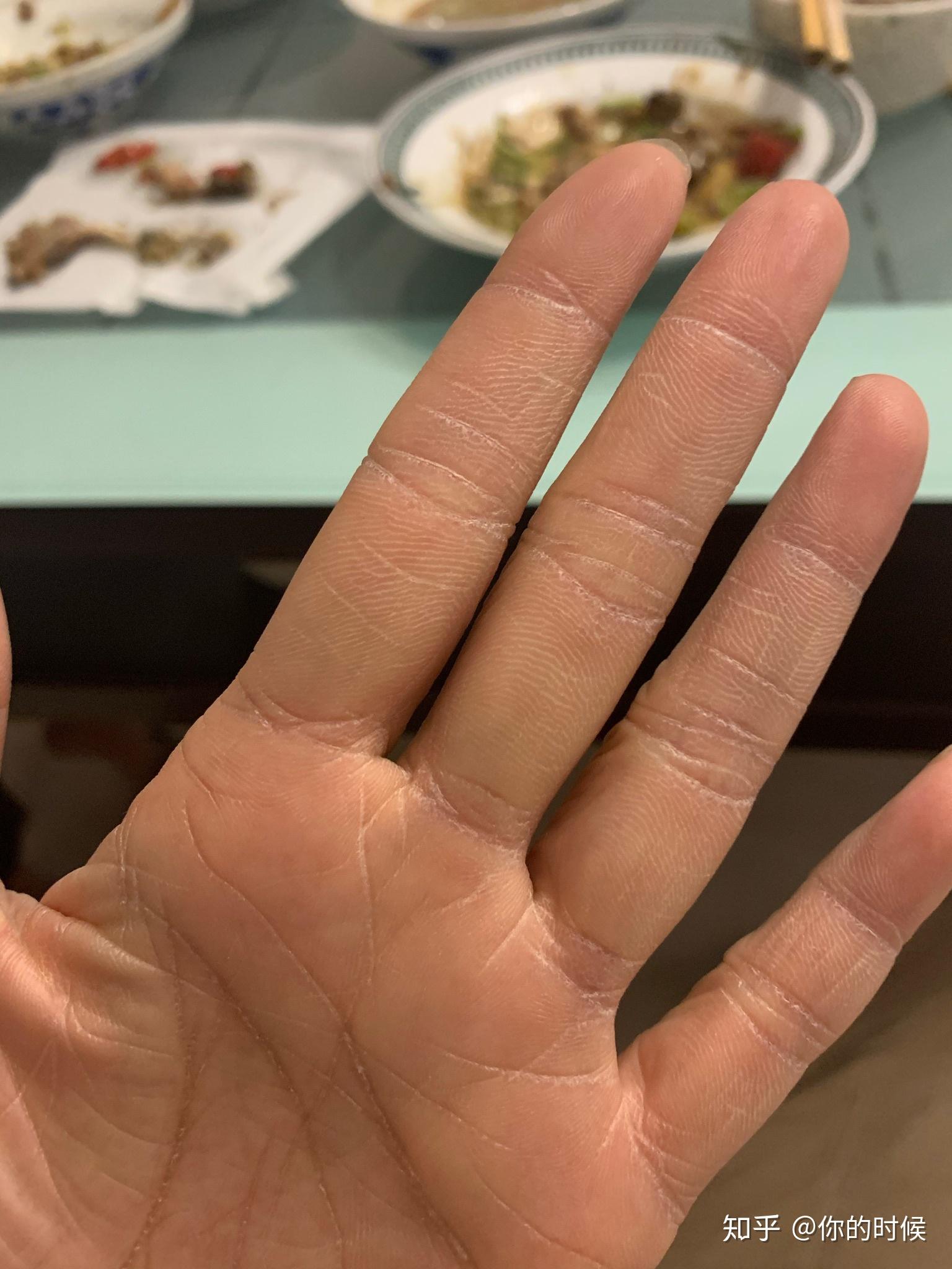 为什么手特别干燥洗手后过一会儿又干燥了尤其是手掌仔细看络纹程白色