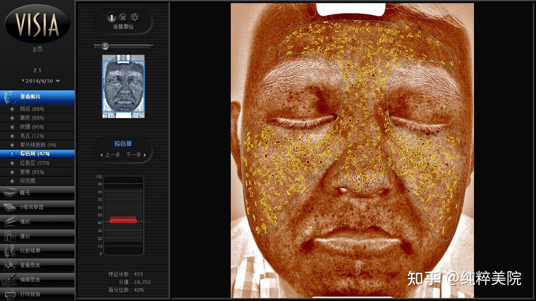 visia皮肤测试结果怎么看?