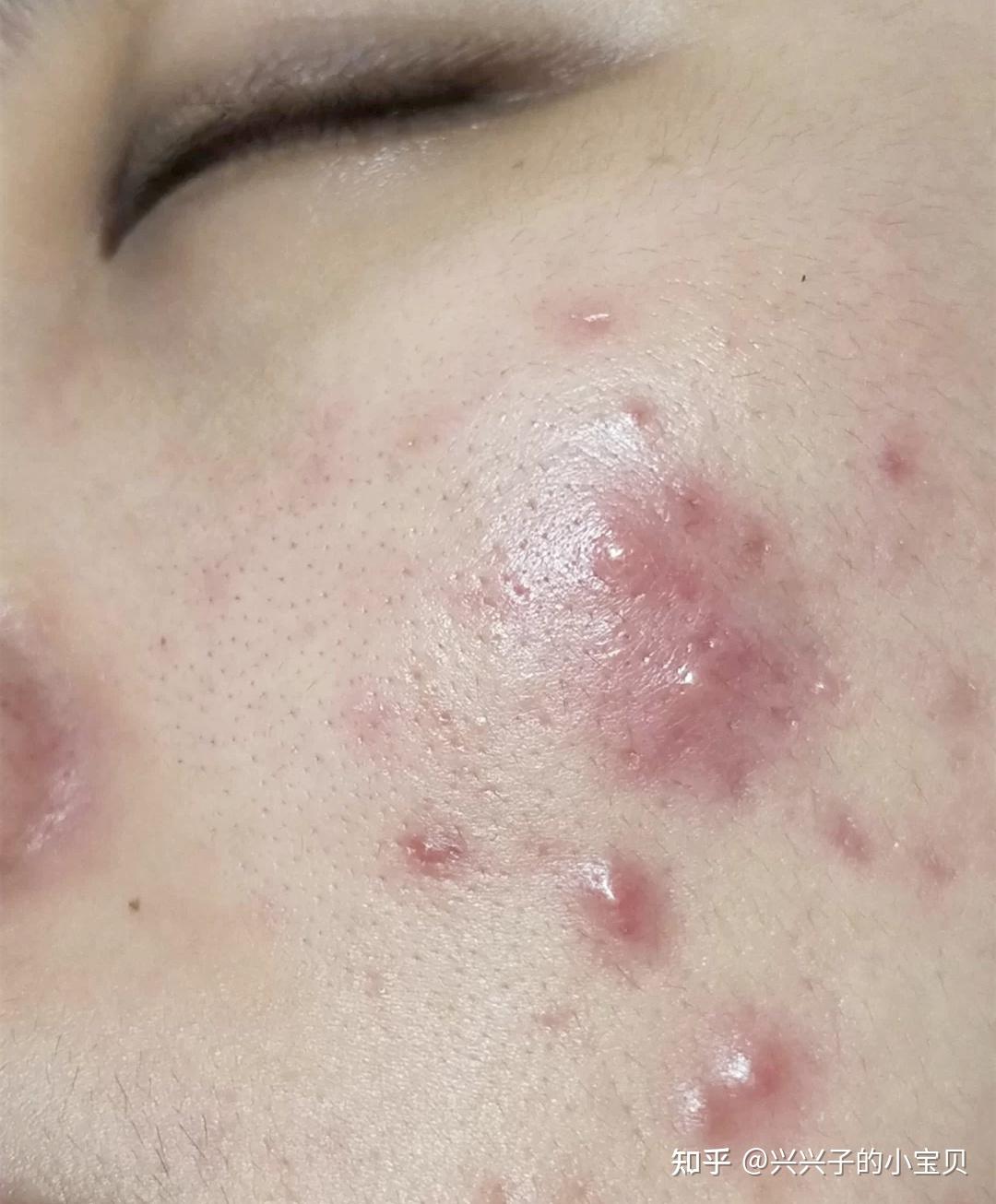 我额头长那种红肿硬的痘痘,半个多月也没消,也不冒白头,我怎么才能让