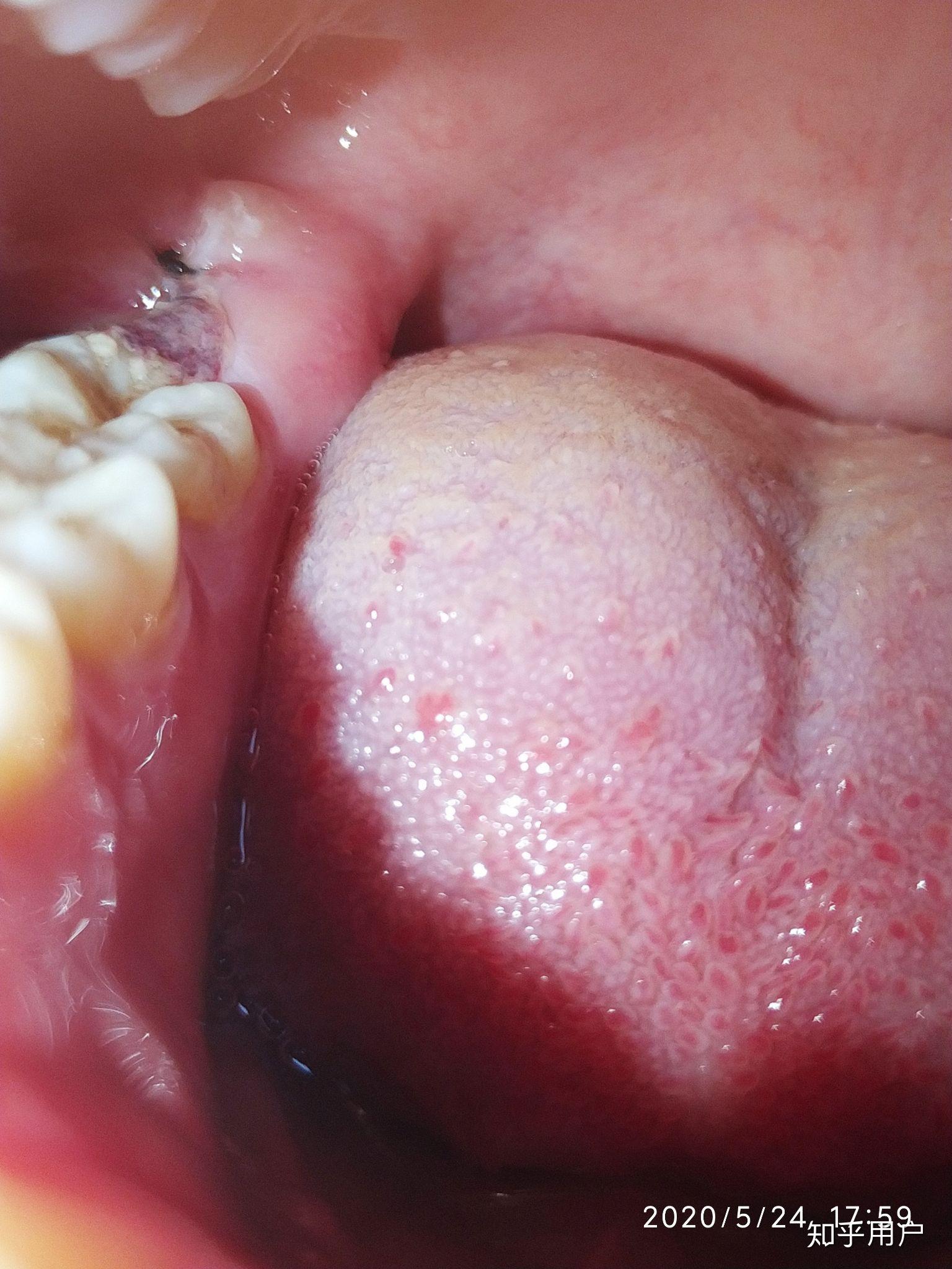 拔了智齿后一直有血块正常吗