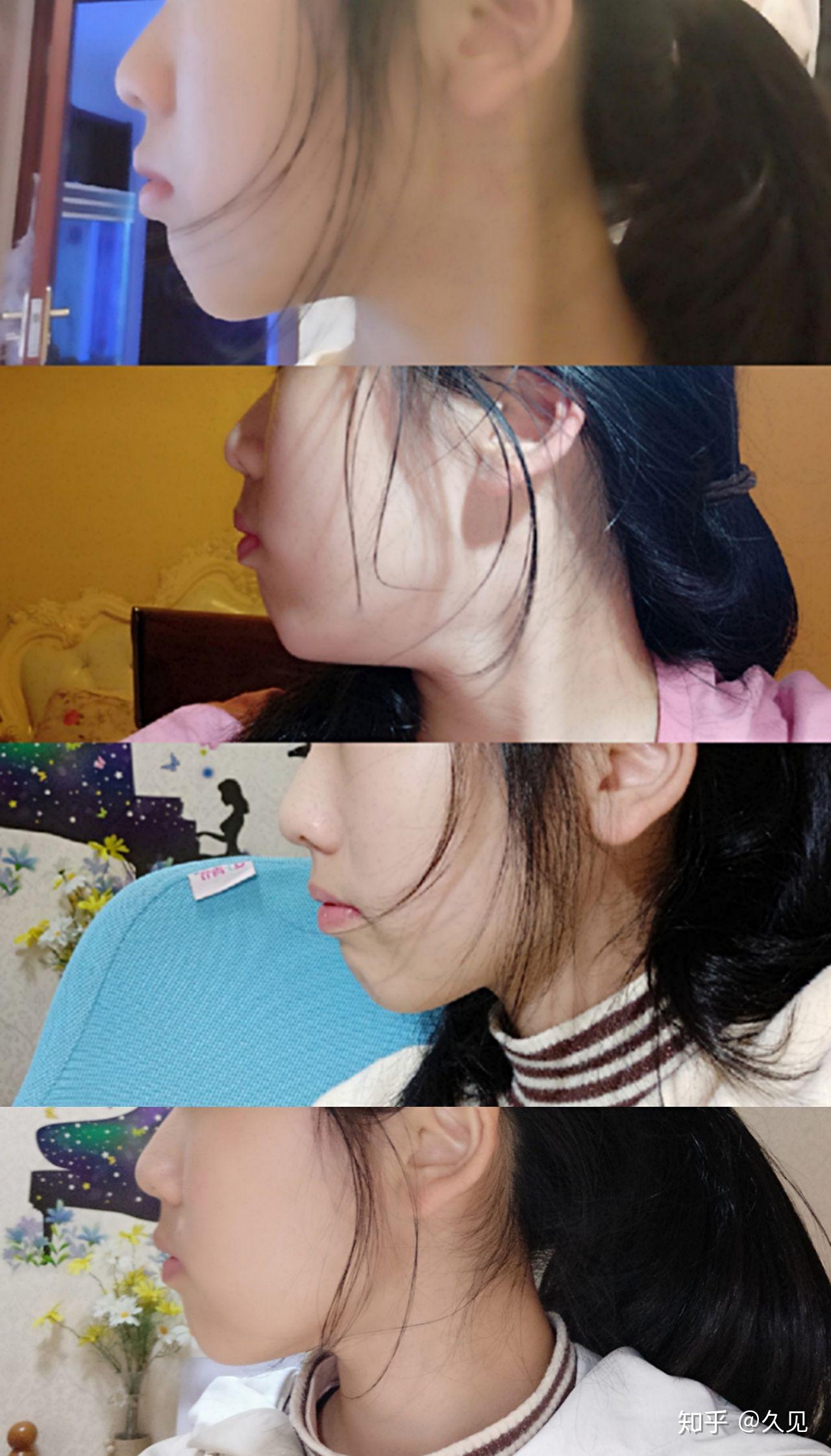 张嘴呼吸面容变丑能恢复吗