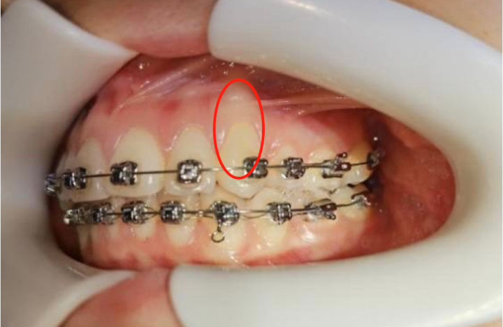 能否科普一下骨开窗
