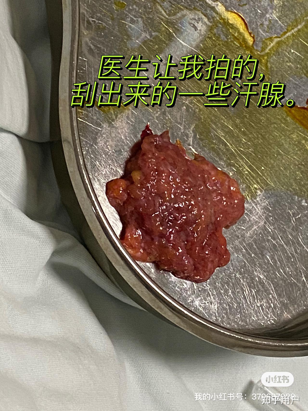 做腋下大汗腺切除手术是什么体验 知乎