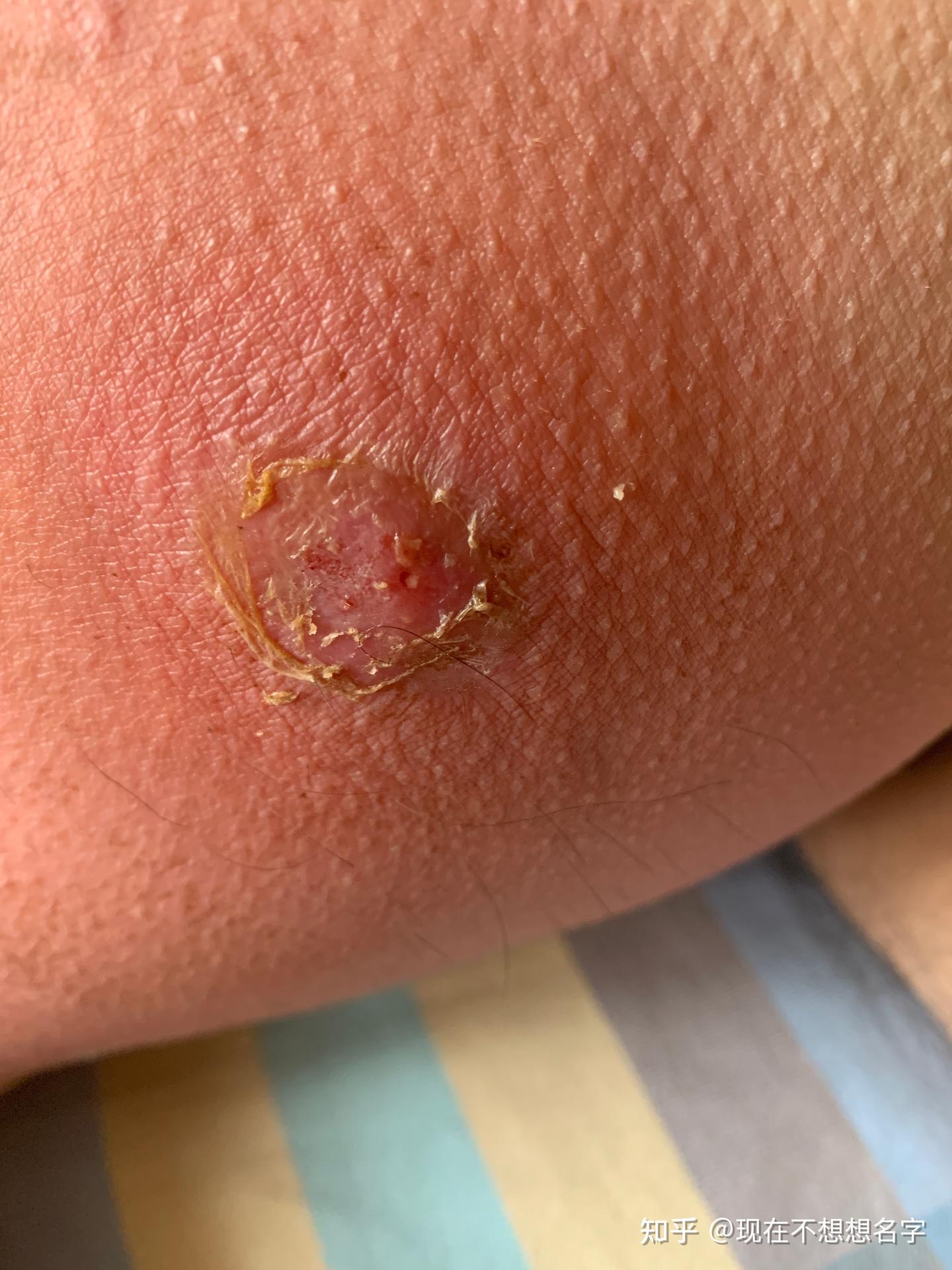 自己处理两次不同的火疖子 - 知乎