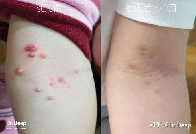 一岁宝宝传染性软疣如何治疗