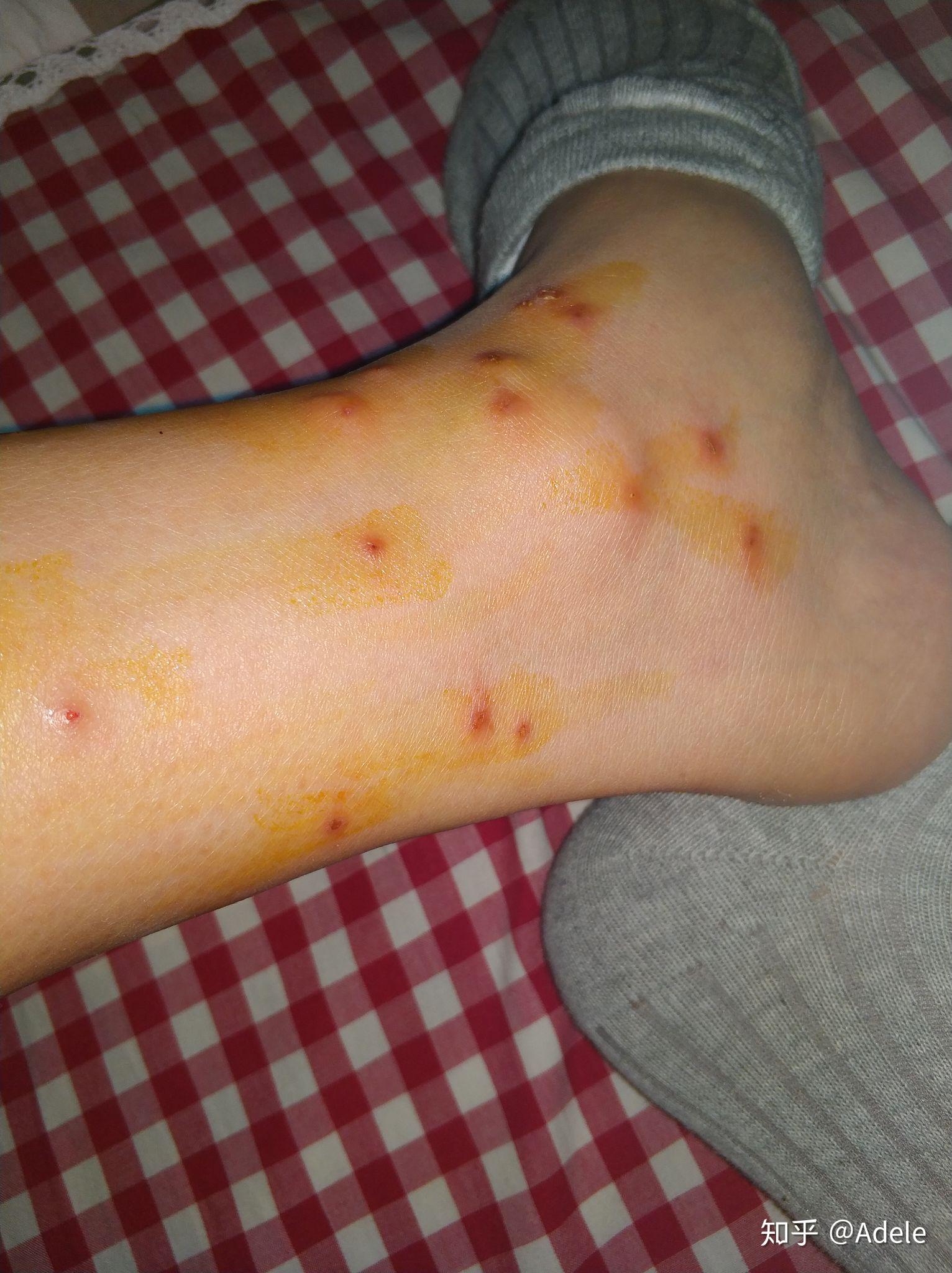 请问被跳蚤咬了有什么药膏能止痒快速消肿的啊? - 知乎