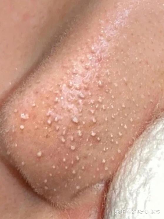 如何消灭毛孔中的油脂粒? - 知乎