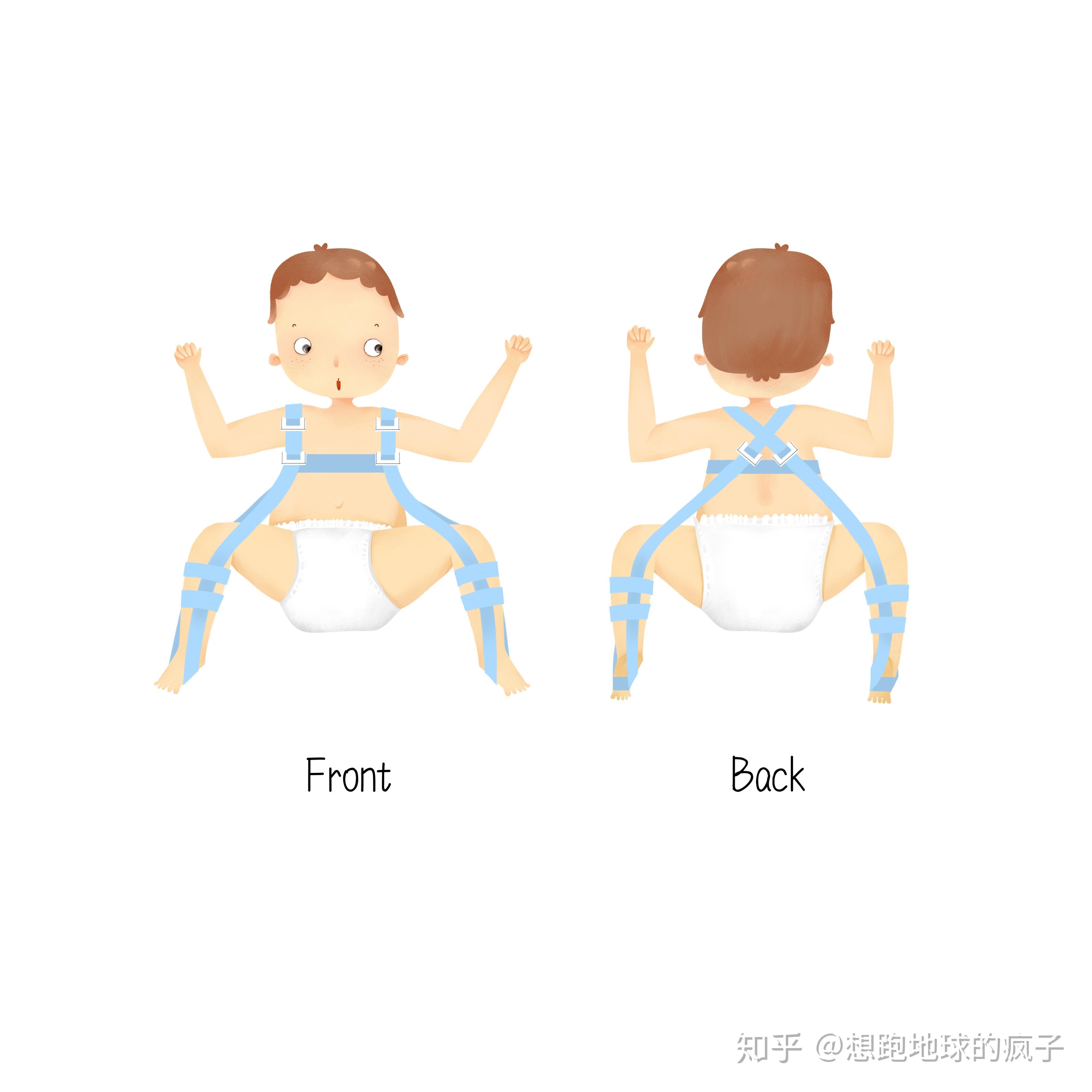 髋关节蛙式抱法示意图图片