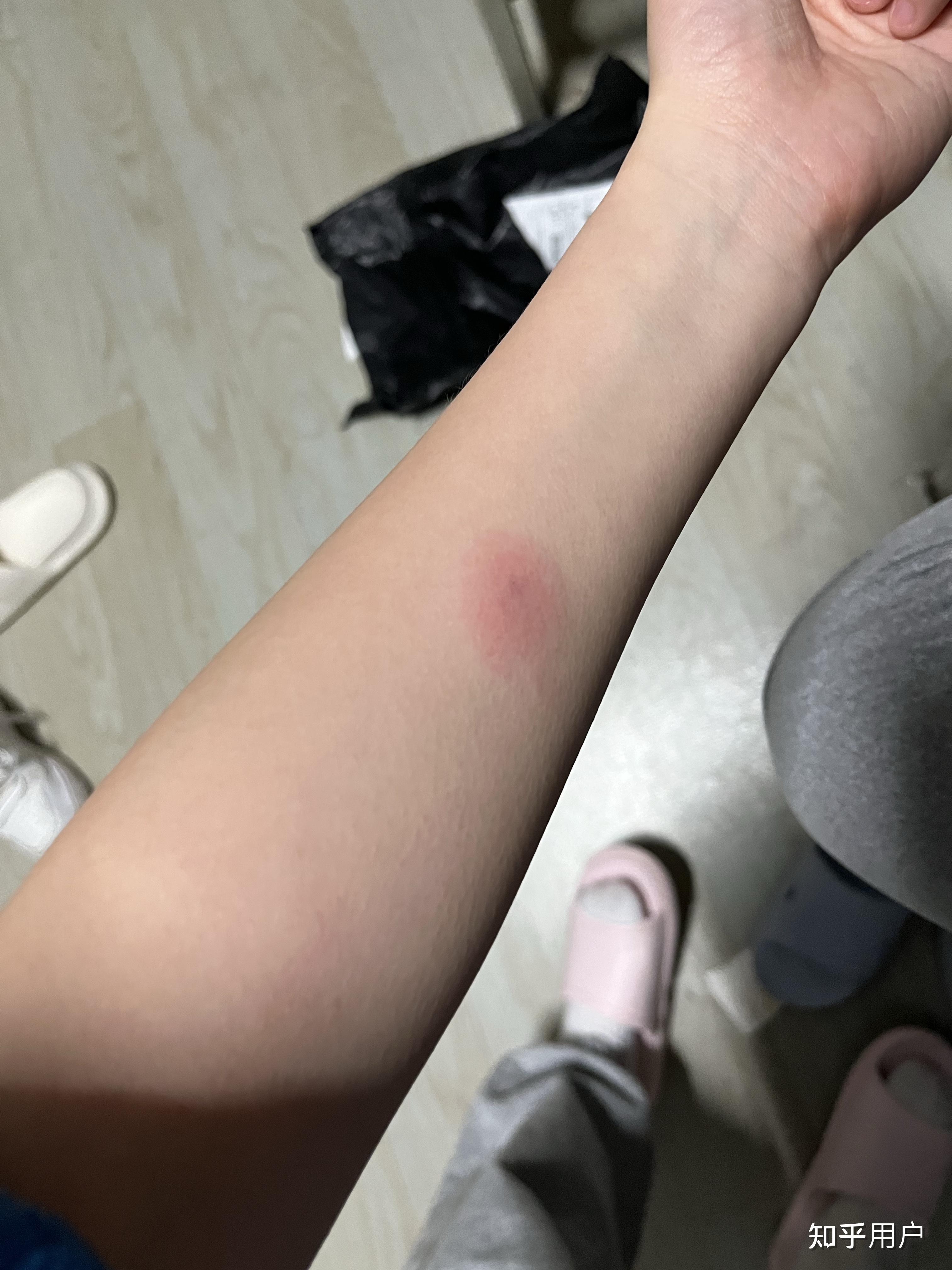 ppd皮试后这个样子怎么办 知乎