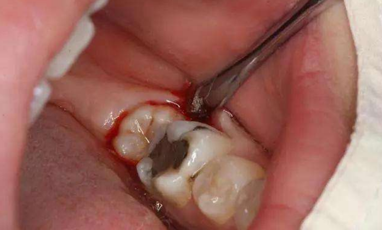 拔完牙后肉里面有大坑食物残渣容易掉进去想知道如何清洁掉
