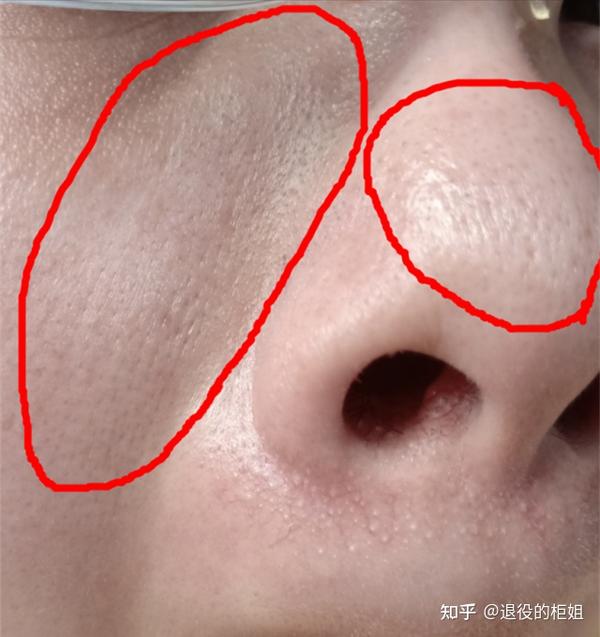 22岁男性油性皮肤,请问鼻子上密密麻麻的黑头如何去?