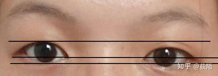高低眉高低眼是怎么形成的怎么改善