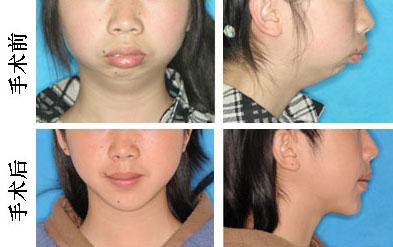 小下颌可以达到怎样的手术效果