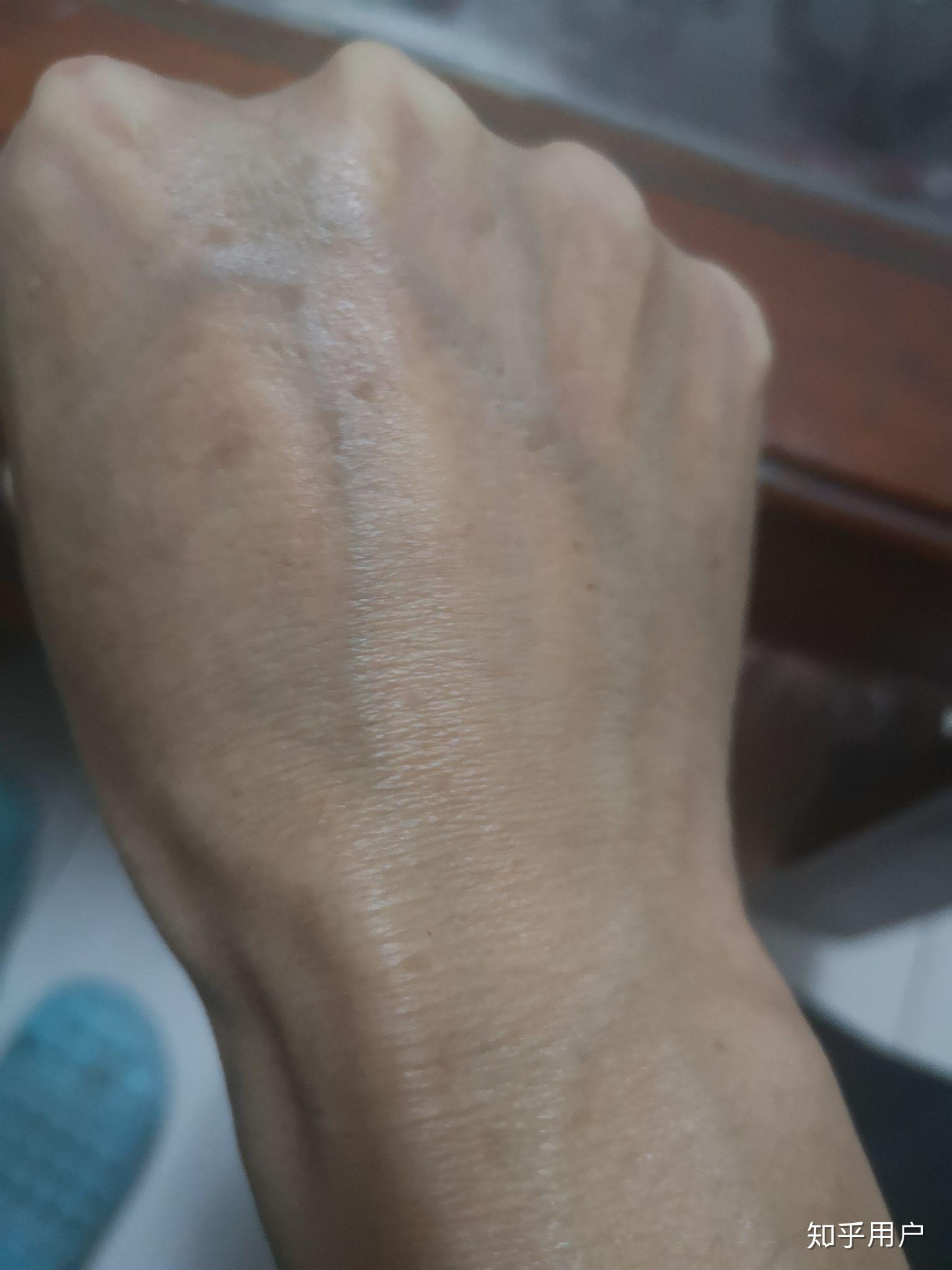 我才33岁,胳膊和手上就开始长老年斑了,太郁闷了,谁知道有什么办法么?