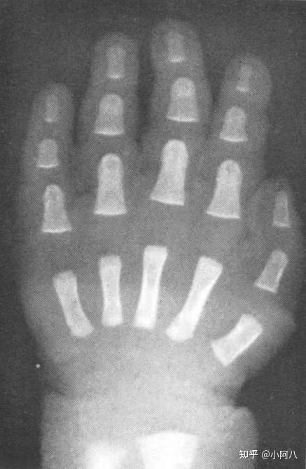 怎样知道自己骨骺线是否闭合