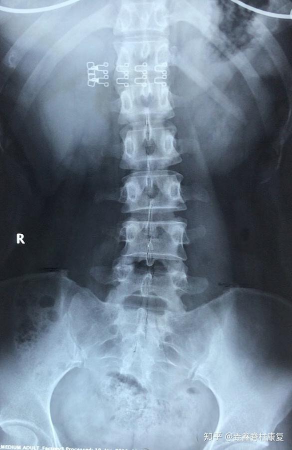 正常腰部x光片图片图片
