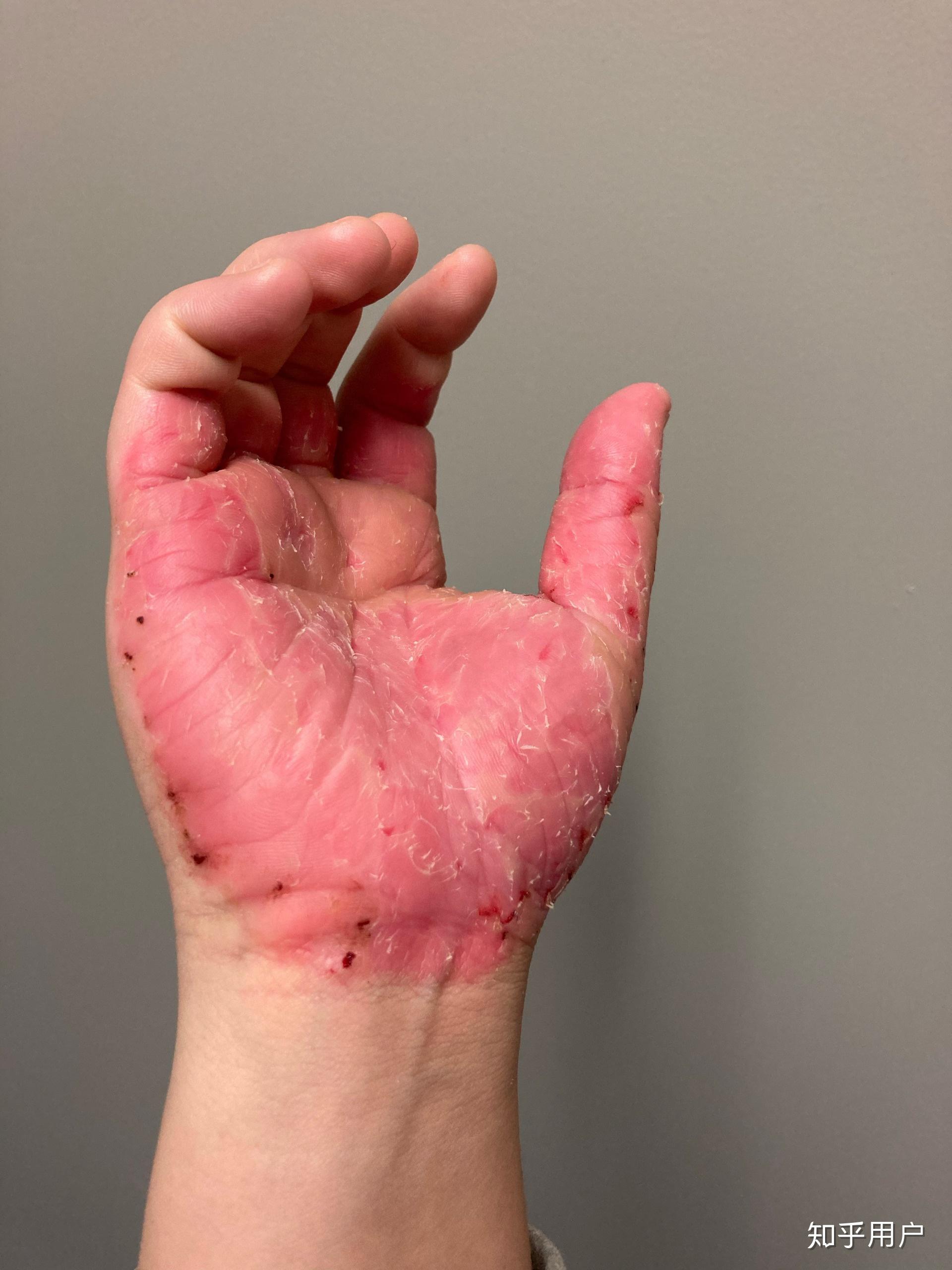 有喜欢抠指甲旁边的皮的吗