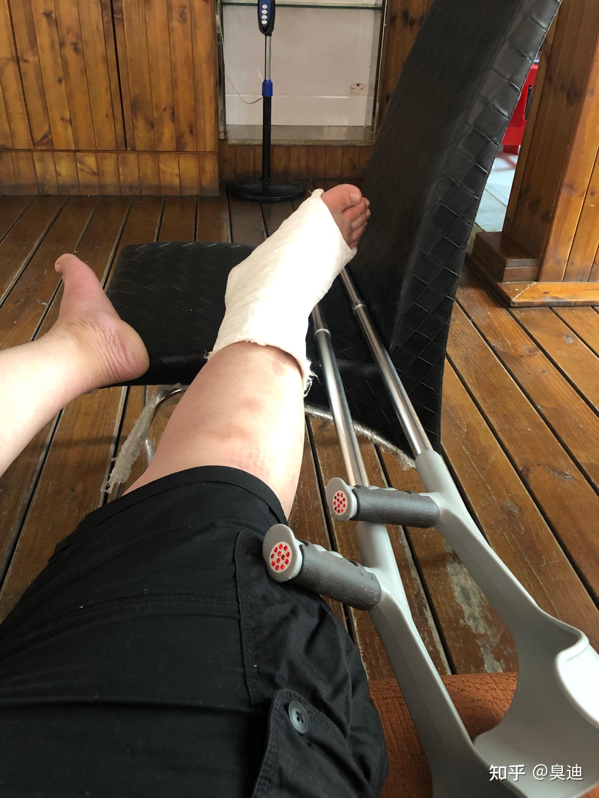 有没有第五拓骨基底骨折两周就下地走路的