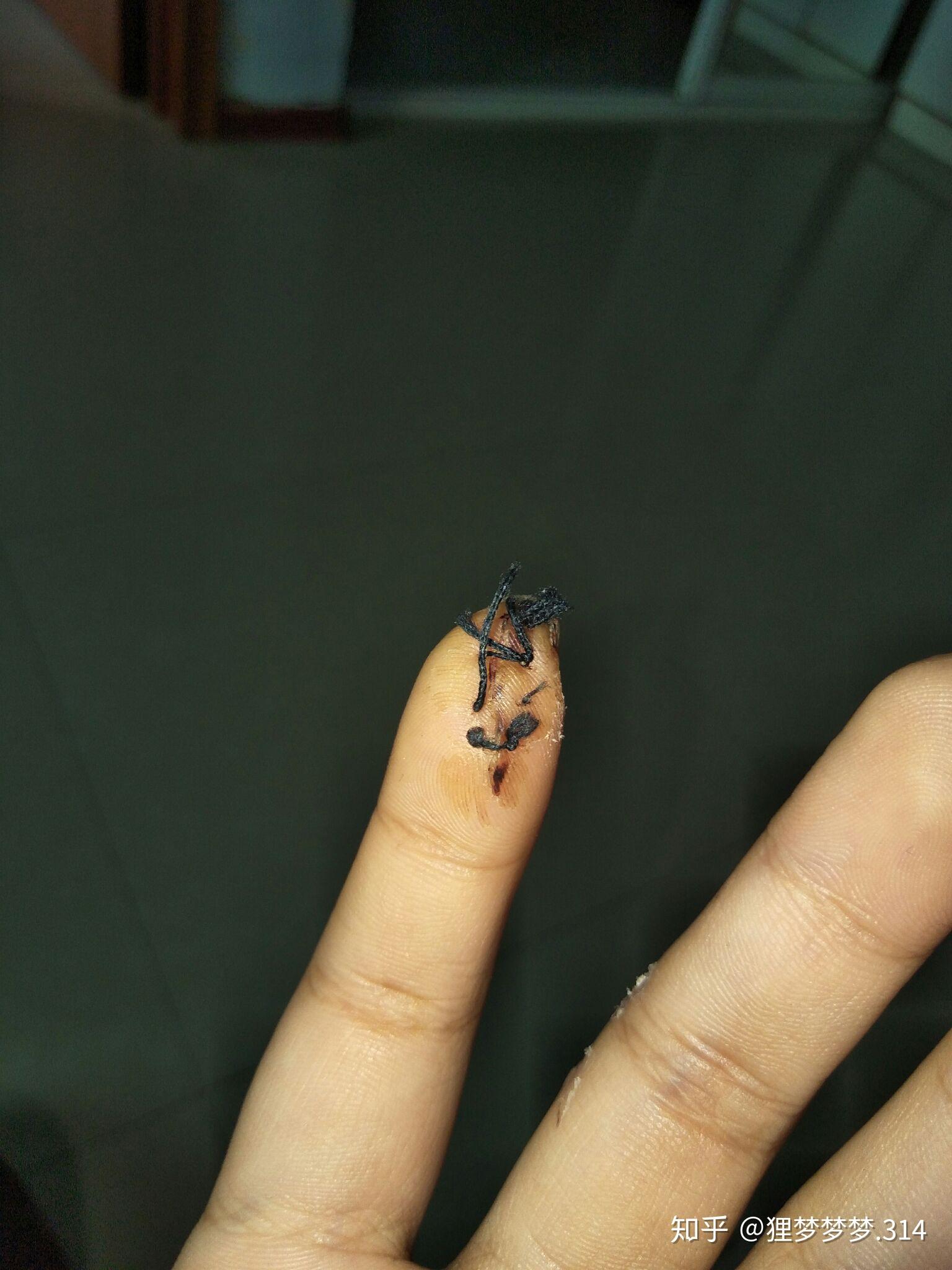 平时手指被割伤应该怎么处理