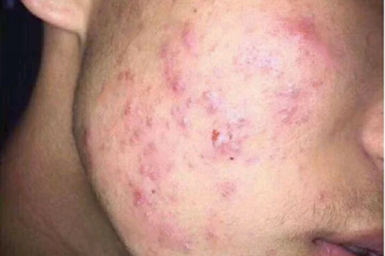 男生脸上爱出油长痘痘用什么护肤品比较好