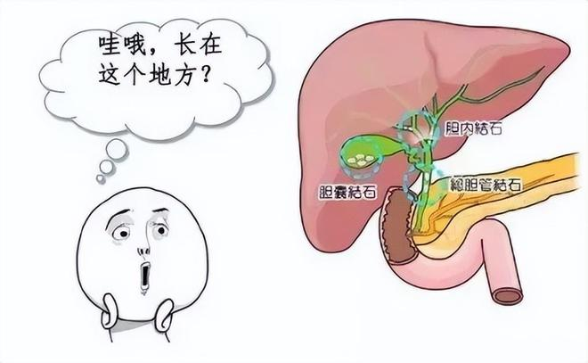 胆结石症状大揭秘!腹痛是预警信号? - 知乎