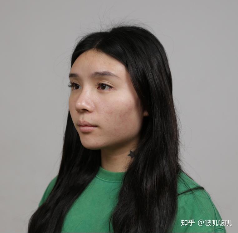 面部轮廓凹凸不平,到底是需要做填充还是做颧骨下颌角? - 知乎