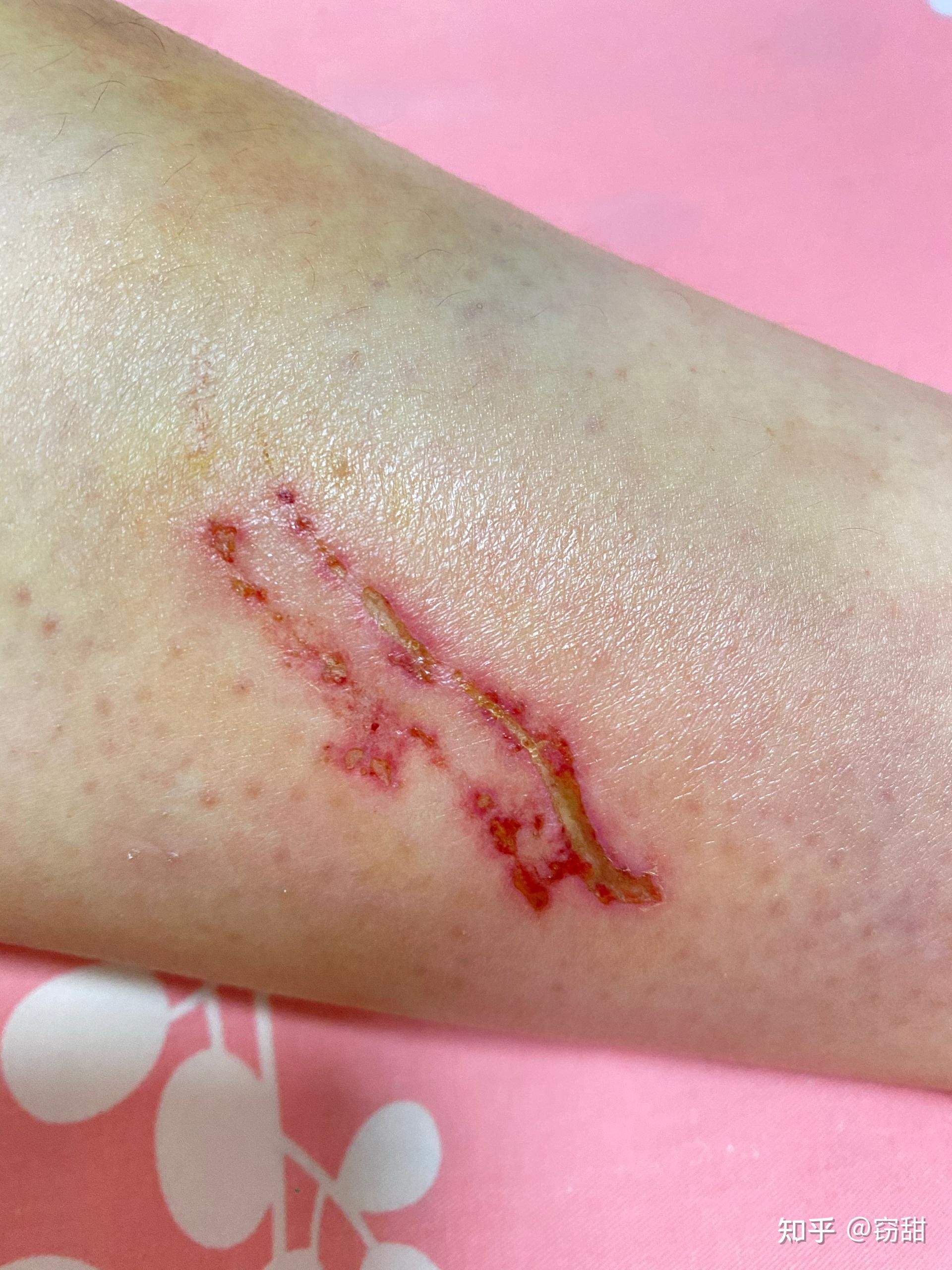 我骑车摔倒,擦破皮,2天后伤口结痂但有白色的东西,该怎么办,什么时候