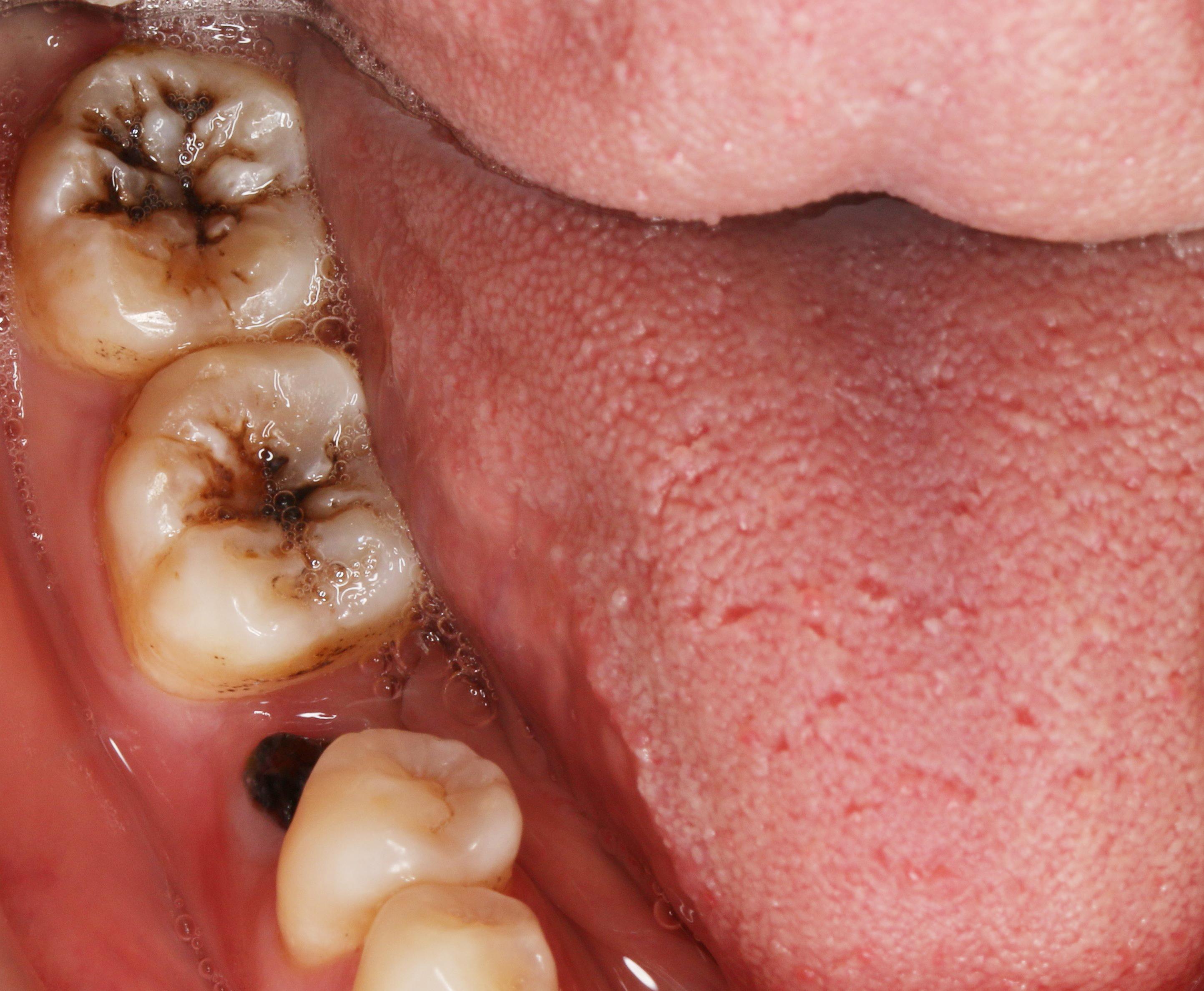 龋齿(蛀牙)能严重到什么地步?